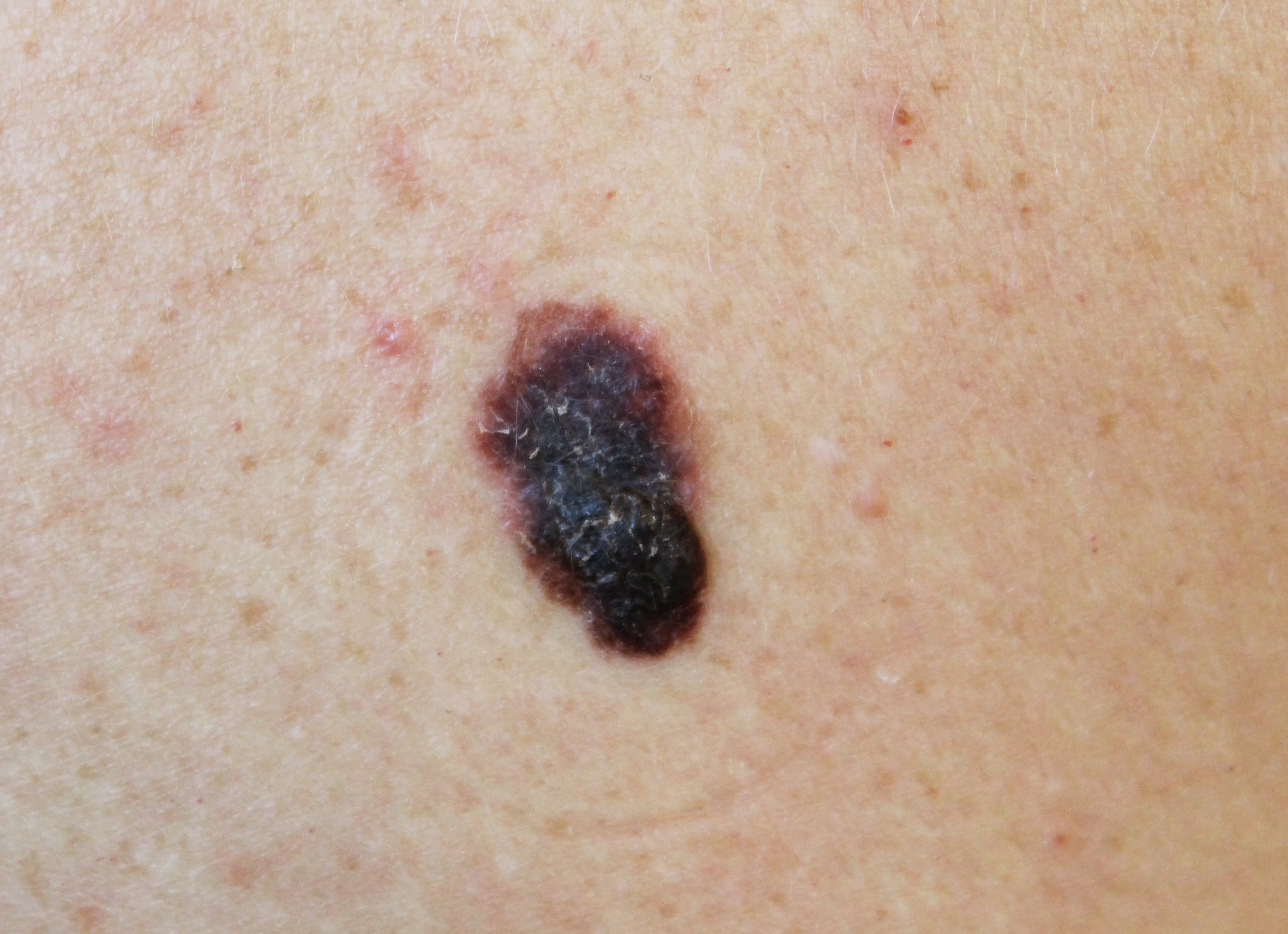 Image of melanoma skin cancer
