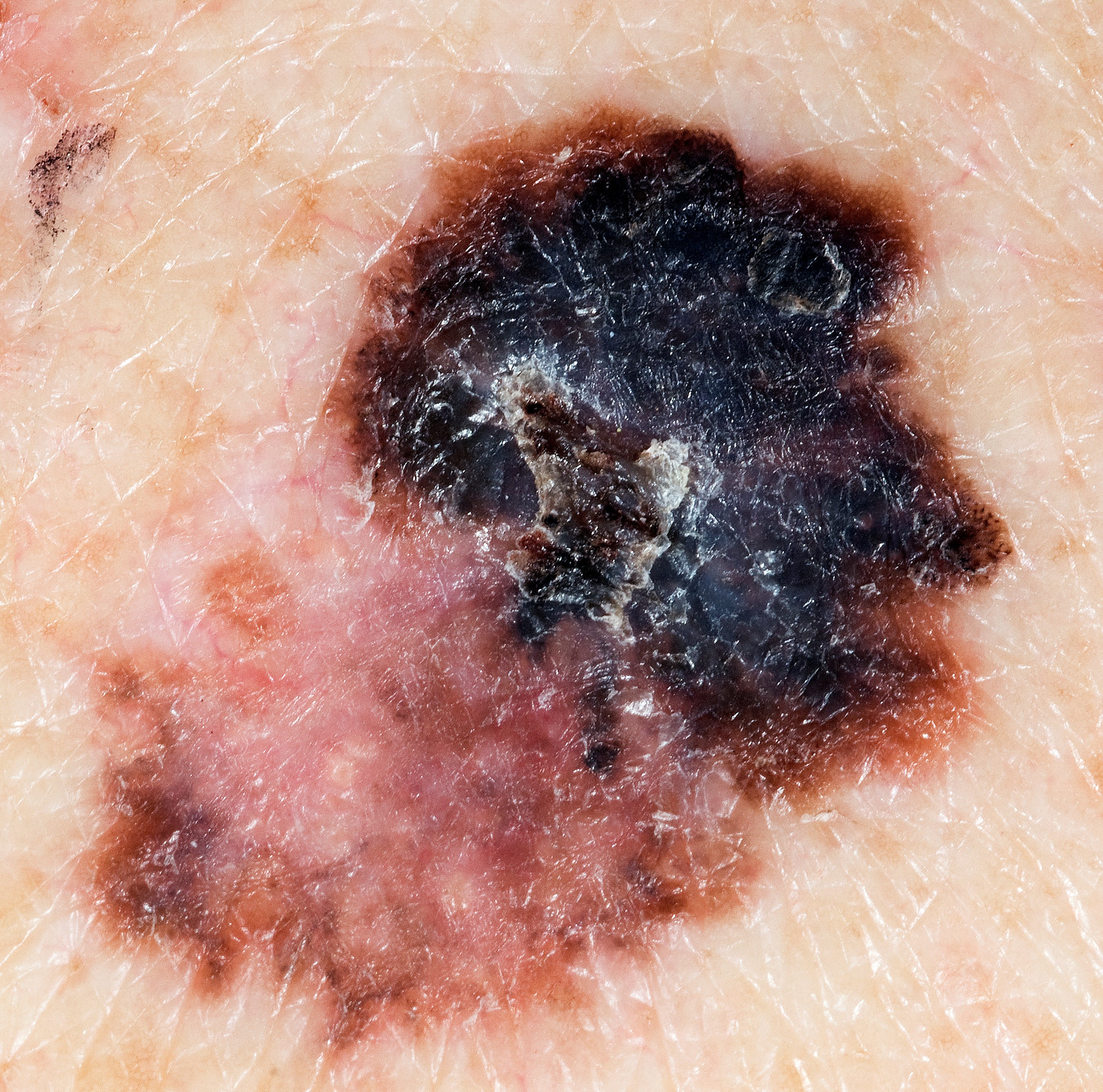 Image of superficial spreading melanoma
