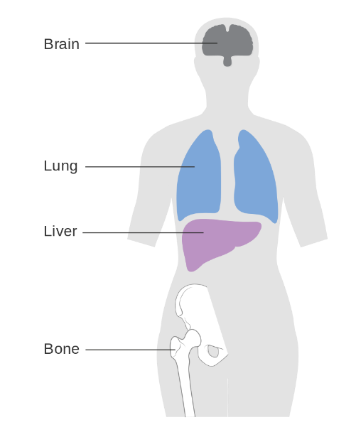 Metastatic breast cancer | Irish Cancer Society