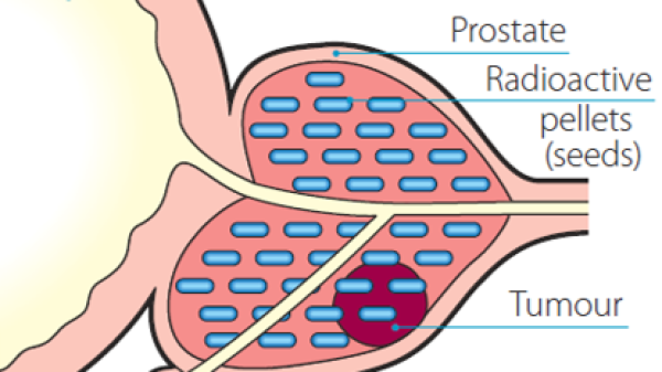 Brachytherapy For Prostate Cancer | Irish Cancer Society