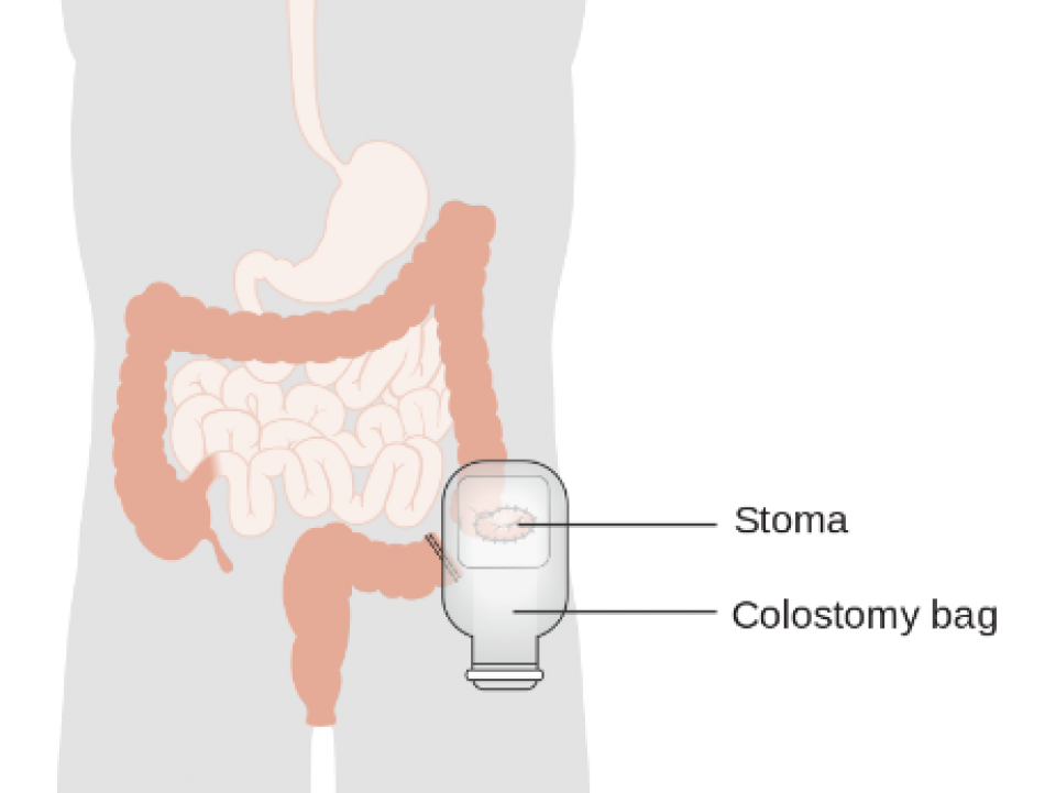 Caring For Your Stoma | Irish Cancer Society