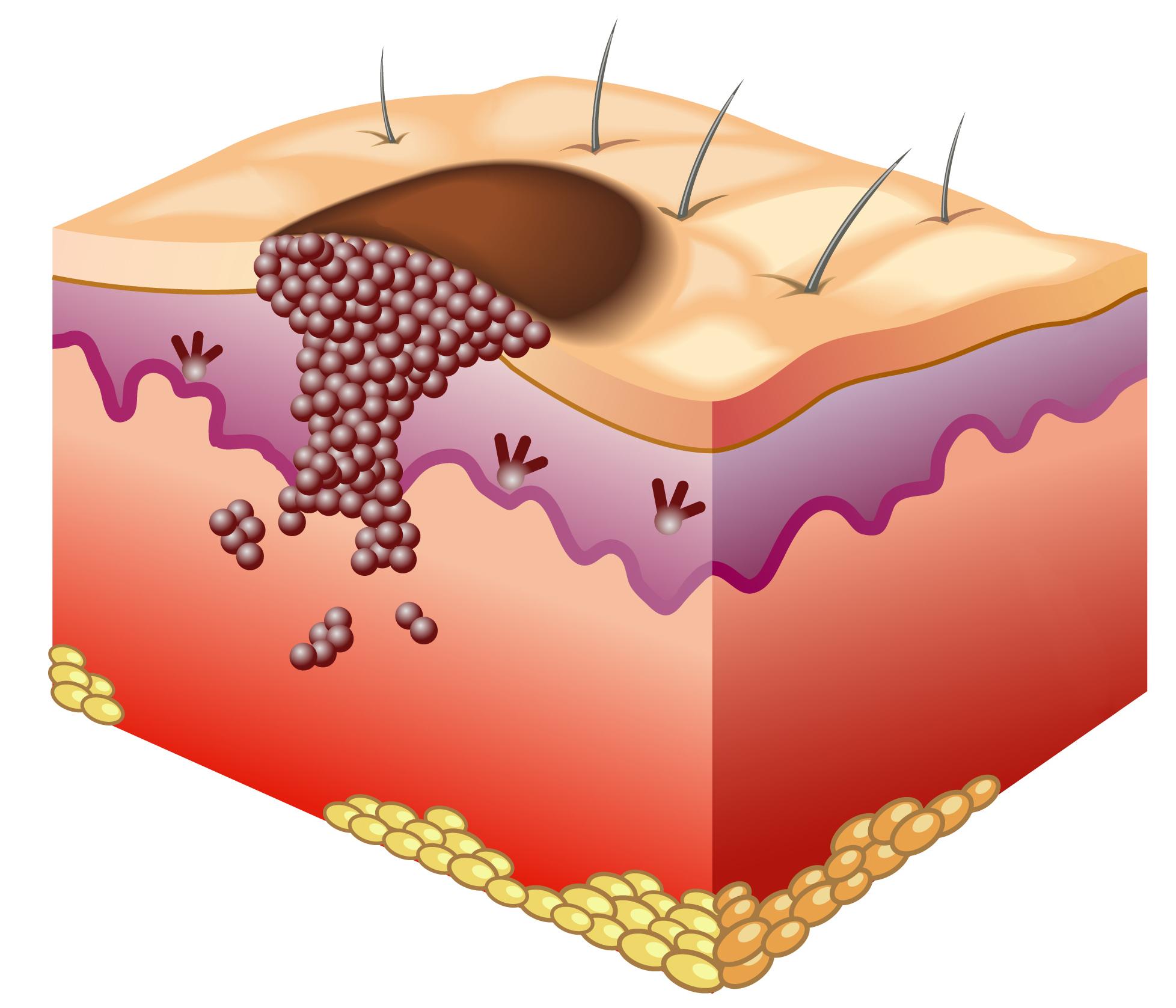 Melanoma Skin Cancer Diagram