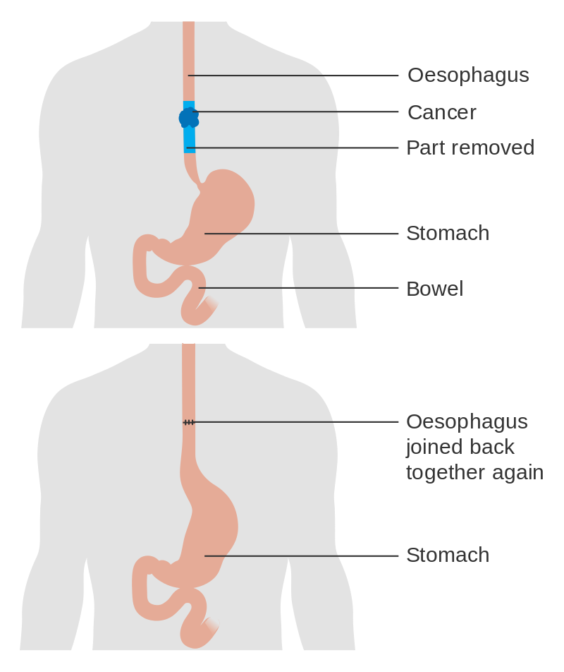 Surgery For Oesophageal Cancer Irish Cancer Society