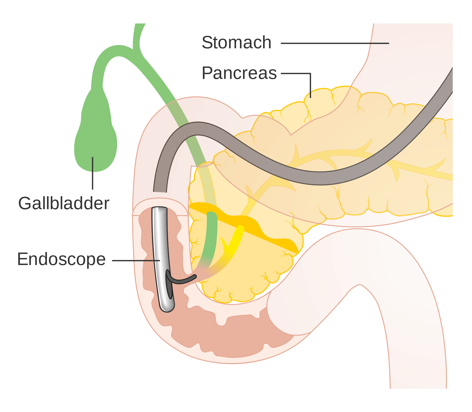 Endoscopic retrograde cholangiopancreatography (ERCP)
